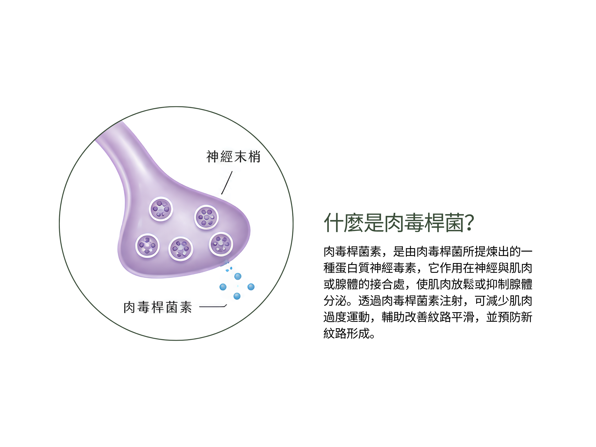 什麼是肉毒桿菌素? 醫美診所療程中,效果顯著、幾乎無恢復期,最受歡迎的應該非肉毒桿菌莫屬了。肉毒桿菌素由美國的眼科醫生發現,最早是運用在眼睛斜視的治療上,後來發現肉毒桿菌素能讓造成皺紋的肌肉放鬆,消除皺紋;也能改善過度發達的肌肉,修飾臉型及腿型,因此大量運用在美容的治療上。 肉毒桿菌素,是由肉毒桿菌所提煉出的一種蛋白質神經毒素,它作用在神經與肌肉或腺體的接合處,使肌肉放鬆或抑制腺體分泌。透過肉毒桿菌素注射,可減少肌肉過度運動,輔助改善紋路平滑,並預防新紋路形成。