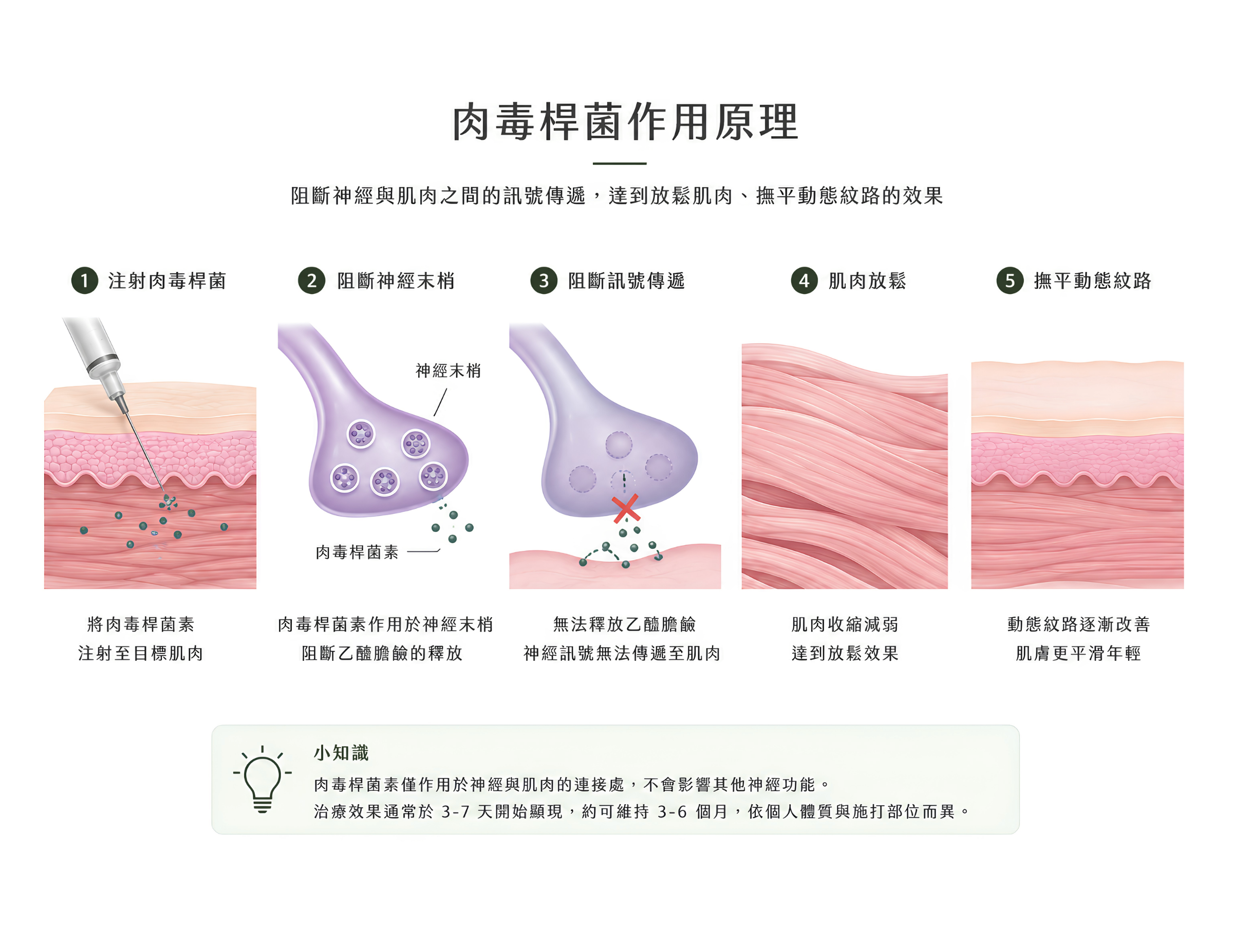 肉毒桿菌素,是由肉毒桿菌所提煉出的一種蛋白質神經毒素,它作用在神經與肌肉或腺體的接合處,使肌肉放鬆或抑制腺體分泌。透過肉毒桿菌素注射,可減少肌肉過度運動,輔助改善紋路平滑,並預防新紋路形成。
